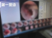 小伙脖子脓肿，开刀发现里面有7颗瓜子藏了20年